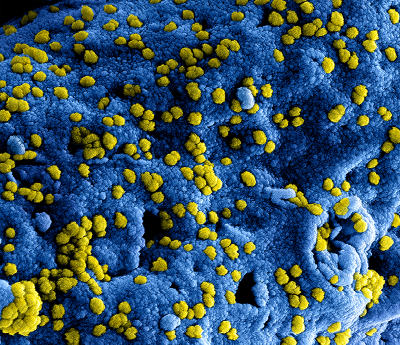 A digitally-colorized scanning electron microscopic image of numerous yellow-colored Middle East respiratory syndrome Coronavirus (MERS-CoV).